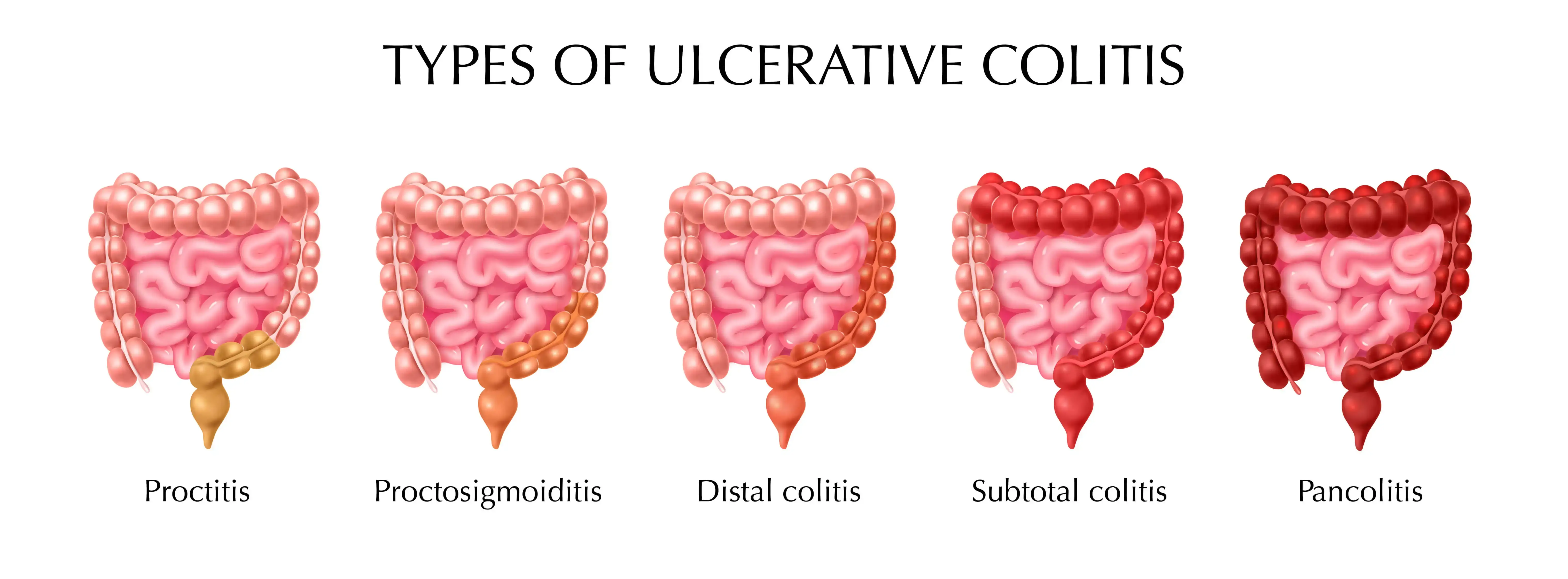 colon cancer