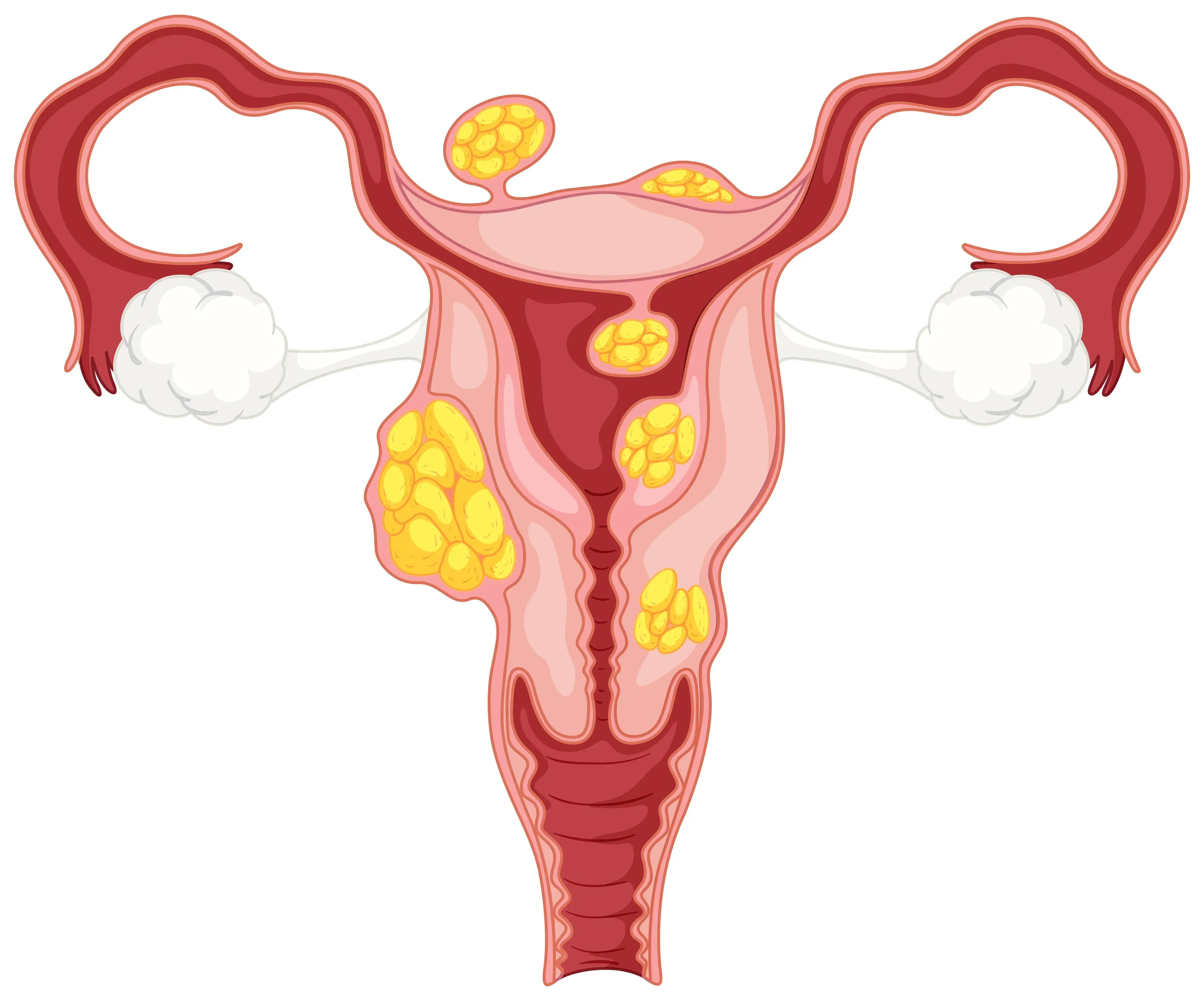 fibroids (1) (1)