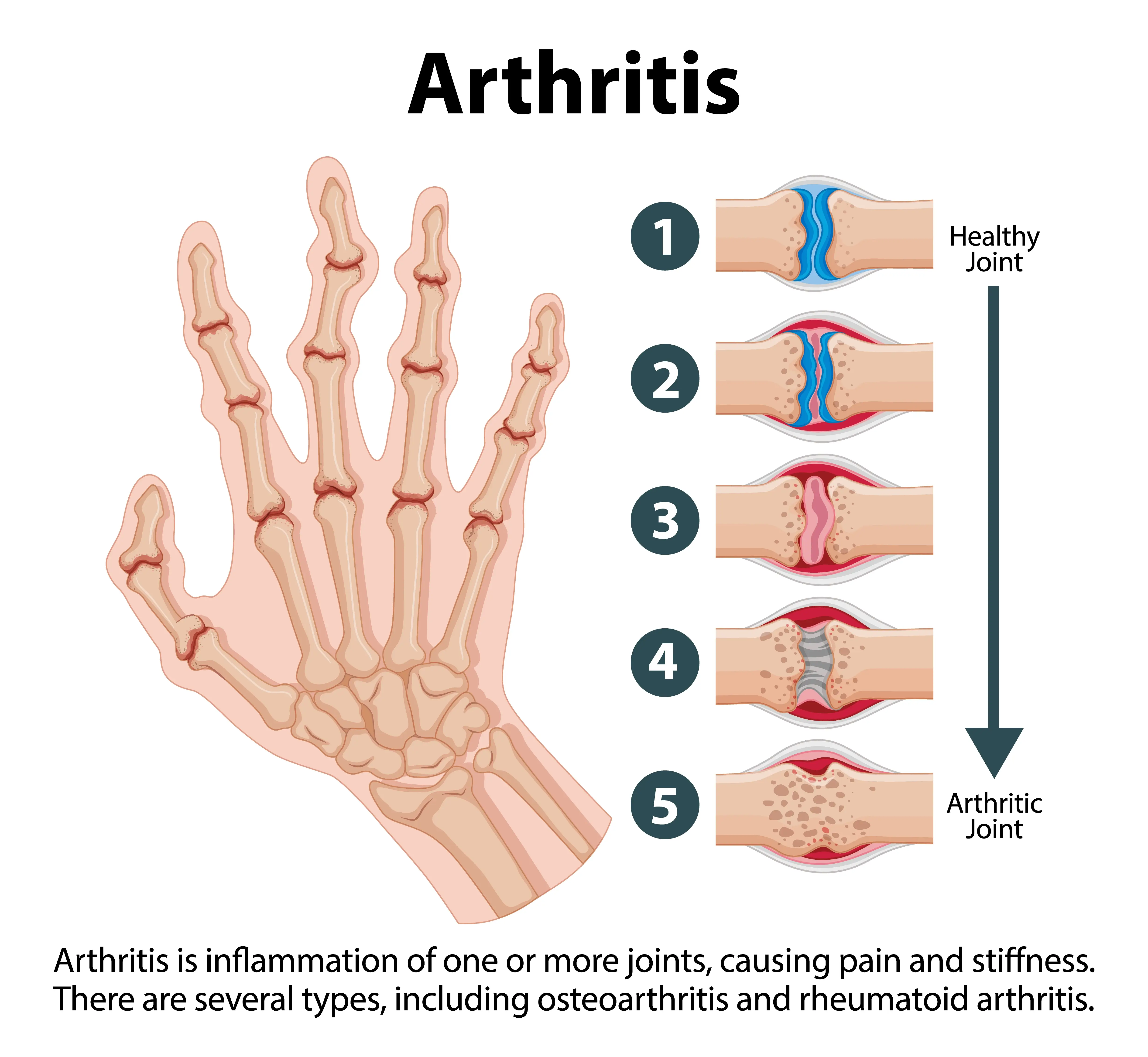 arthritis stages (1)