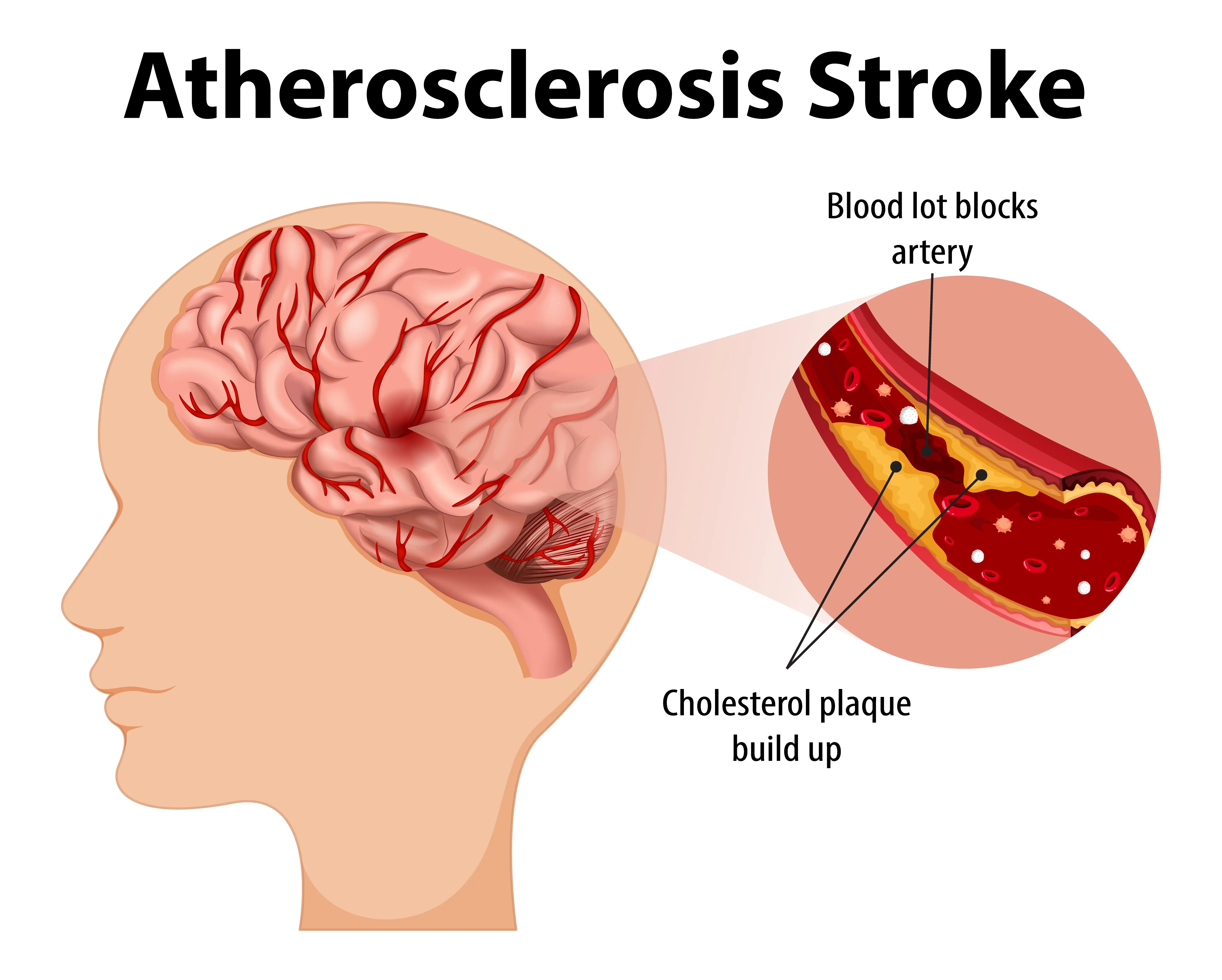 atherosclerotic stroke