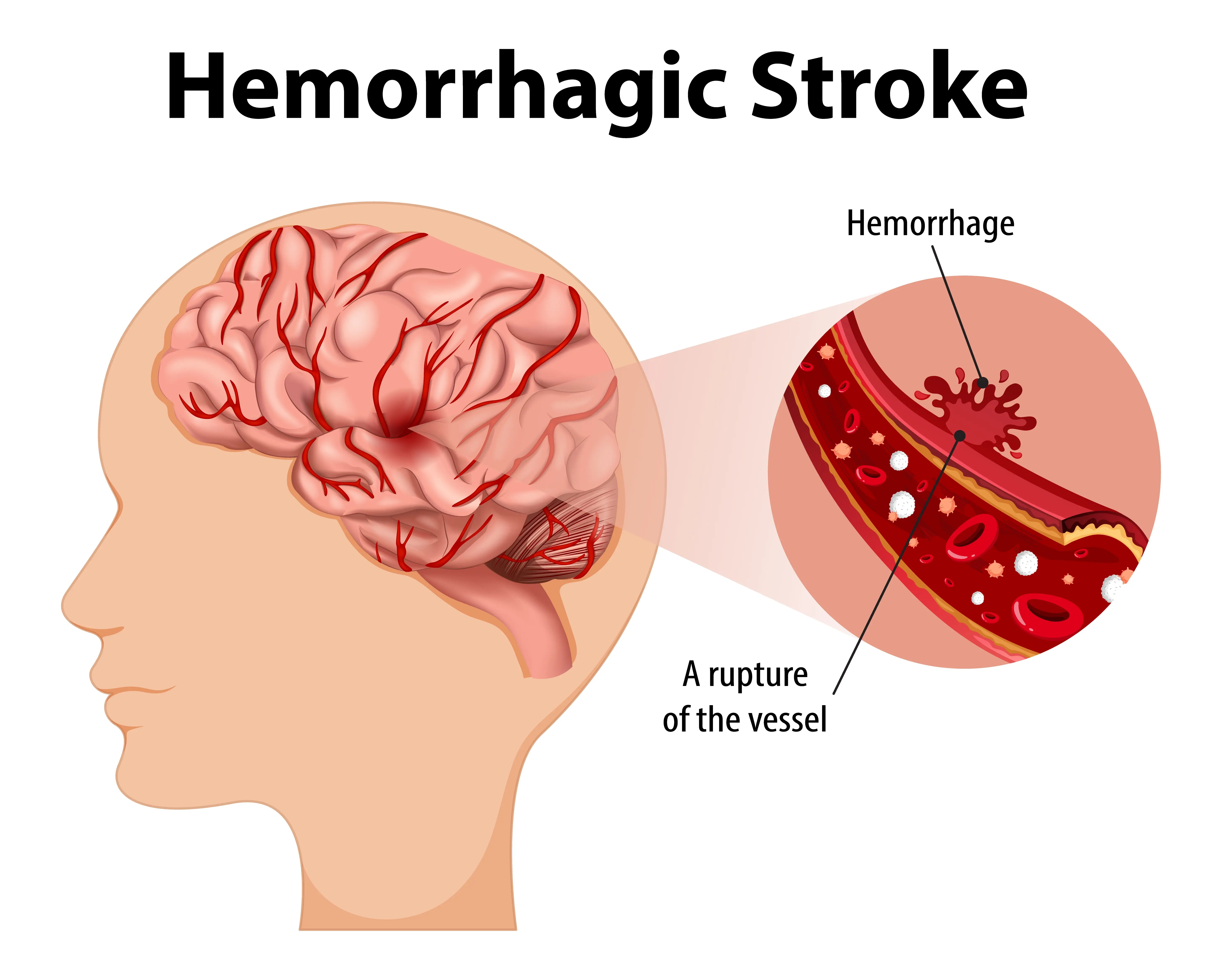 Hemorrhagic stroke