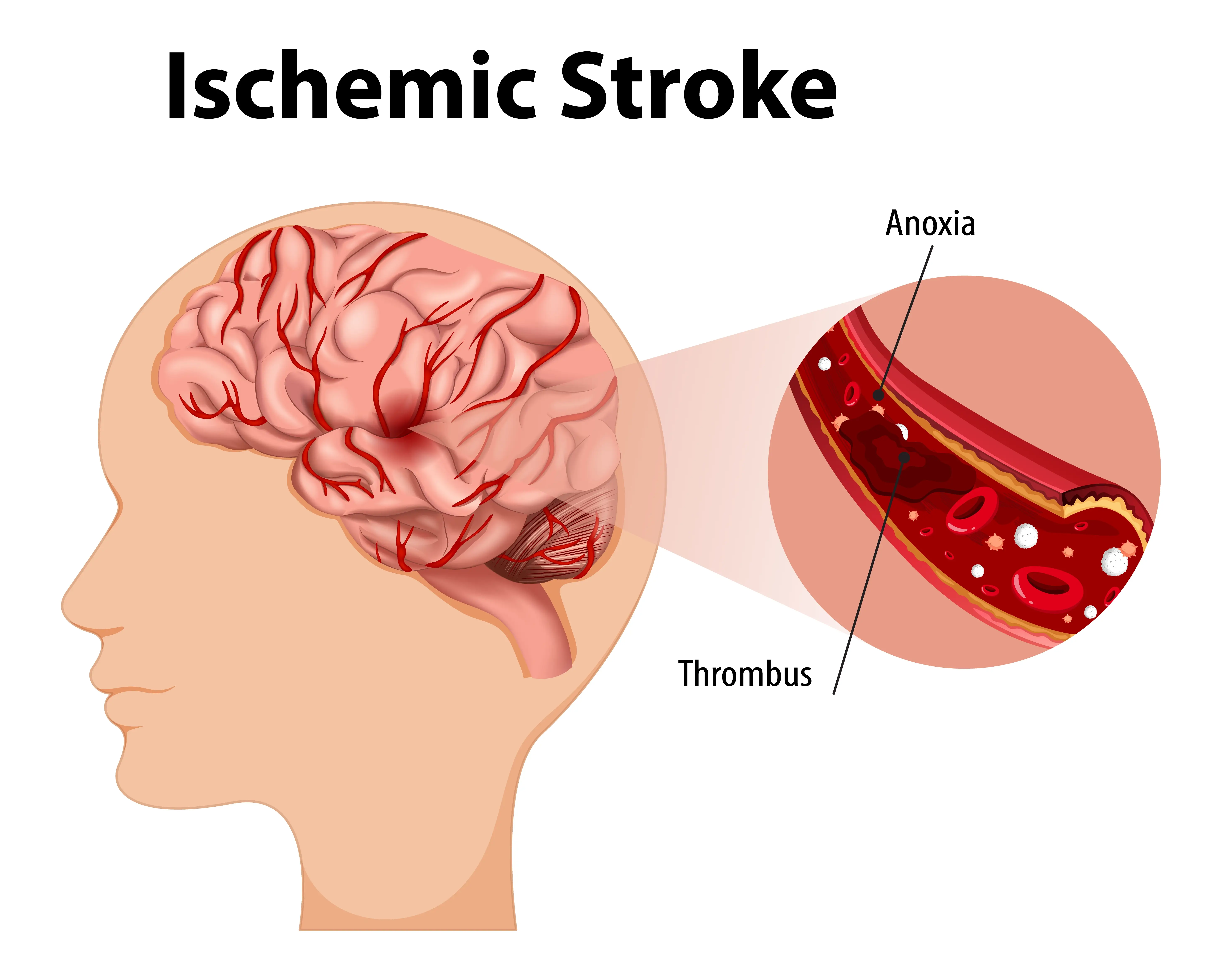 Ischemic Stroke