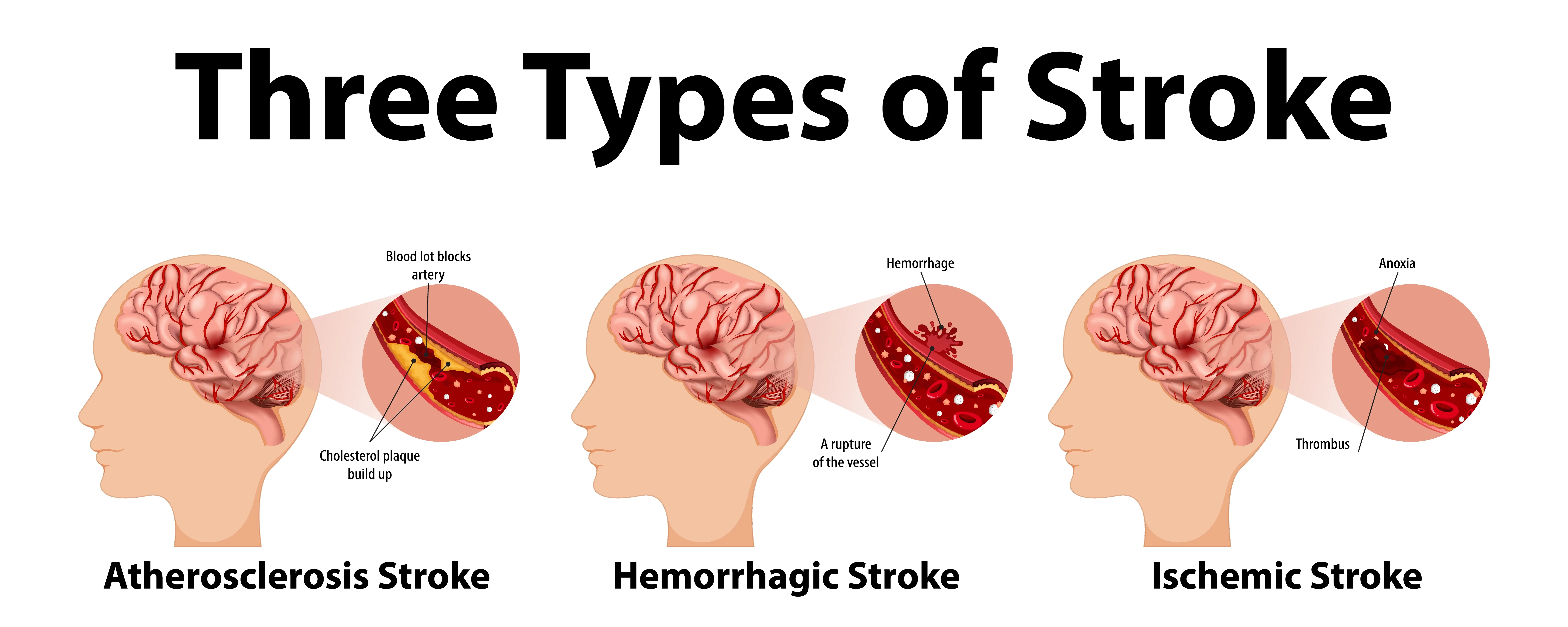 types of stroke -1