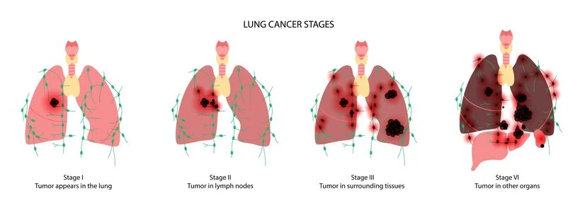 lung cancer