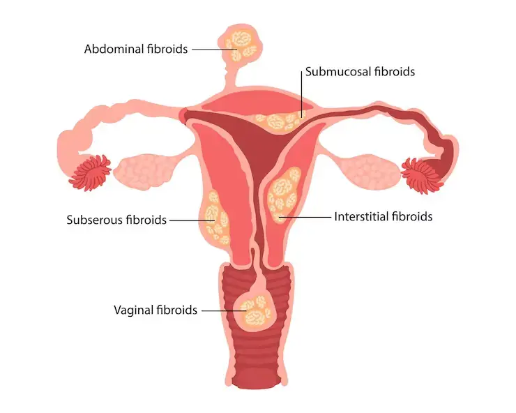 Types of Fibroids