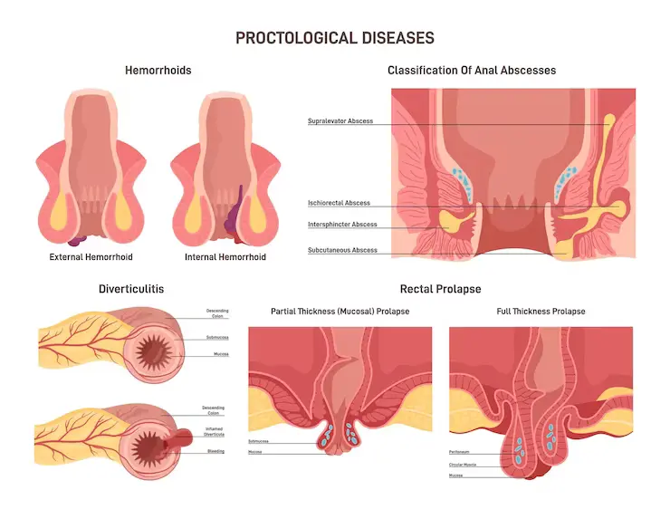 Hemorrhoids from joshoppers